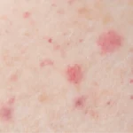 Kawasaki disease in adults