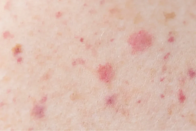 Kawasaki disease in adults