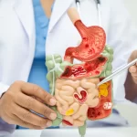 Crohn’s Disease