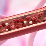 Peripheral Artery Disease (PAD): Understanding Causes, Symptoms, and Treatments