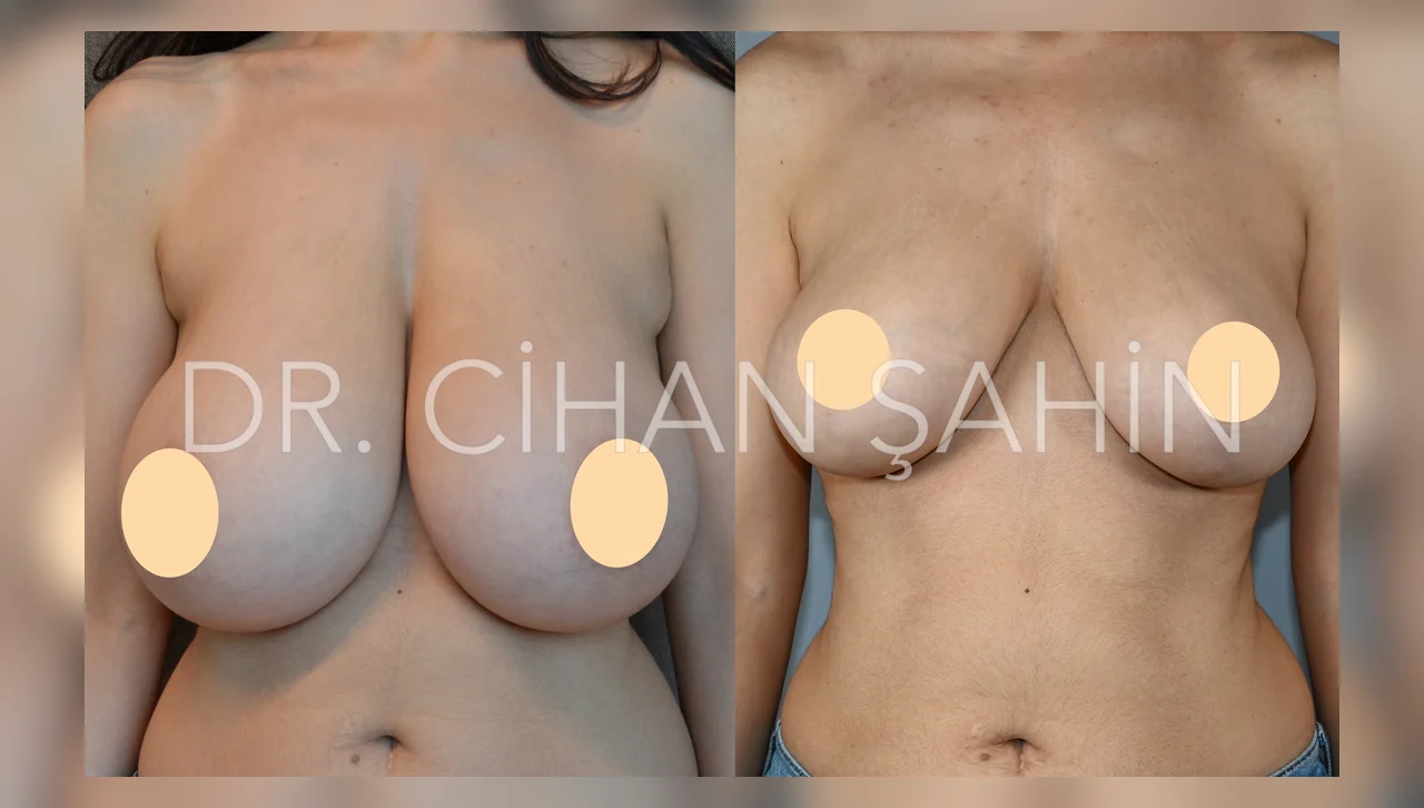 Breast Reduction
